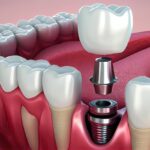Transform Your Smile: A Practical Guide to Dental Veneers and Where to Find Them