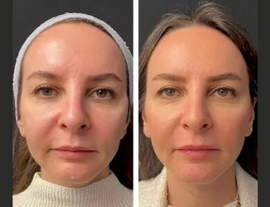 How the Best Plastic Surgeons in Dubai Perform Mesotherapy for Hair Loss