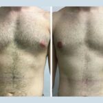 Top Clinics with the Best Doctors in Dubai for Male Breast Reduction