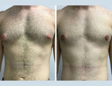Top Clinics with the Best Doctors in Dubai for Male Breast Reduction