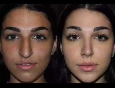 Septoplasty in Dubai vs. Other Treatments