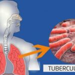 TB Doctor in Varanasi: Trusted Diagnosis & Treatment for Tuberculosis