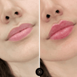 Avoiding Bruising After Dermal Fillers Treatment in Dubai