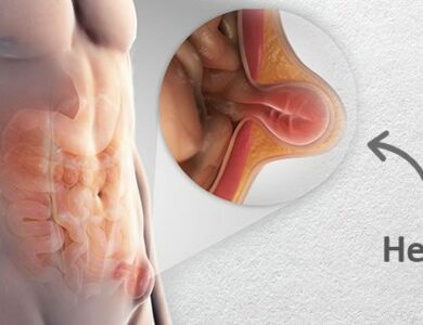 Best Laparoscopic Hernia Surgery in Guwahati: Get Advanced and Painless Treatment | GI Surgery