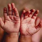 Throwing Up with Hand, Foot, and Mouth Disease: Is It Normal?