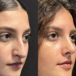 How Do the Best Doctors in Dubai Ensure a Safe Rhinoplasty Experience?