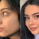 Best Doctors in Dubai: Why Are They Preferred for Male Rhinoplasty?