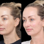 Cheek Fillers: Why the Best Aesthetic Clinic in Dubai Makes All the Difference