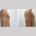 The Confidence Boost from Gynecomastia Surgery in Dubai