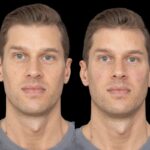 Under Eye Fillers: Discover the Best Aesthetic Clinic in Dubai for Instant Glow