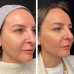 Mesotherapy in Dubai: How Many Sessions Do You Really Need?