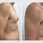 How Location Influences the Overall Breast Reduction Cost in Dubai
