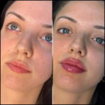 Fillers Treatments in Dubai Using Juvederm and Hyaluronic Acid for Long-Lasting Results