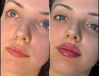 Fillers Treatments in Dubai Using Juvederm and Hyaluronic Acid for Long-Lasting Results