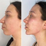 How Endolift in Dubai Delivers Real Results Without Surgery