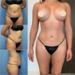 Discover How the Best Body Contouring Surgeons in Dubai Achieve Stunning Results