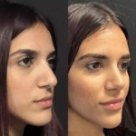 Best Doctors in Dubai for Rhinoplasty Before and After Results