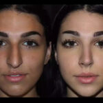 What Makes the Best Doctors in Dubai Ideal for Septoplasty Patients?