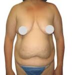 Top 5 Benefits Of Combining Procedures In Your Mommy Makeover