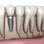 Dental Implants in Jumeirah | Zenon Dental Clinic