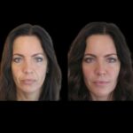 Best Plastic Surgeons in Dubai for Jawline Fillers – A Celebrity’s Secret to a Defined Look