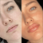 Glow Instantly at the Best Aesthetic Clinics in Dubai for Fillers