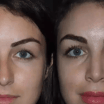 Rhinoplasty in Dubai for a Broken Nose – Full Restoration