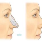 How Rhinoplasty in Islamabad Can Improve Your Facial Features