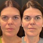 Top Benefits of Getting a Thread Lift at the Best Aesthetic Clinic in Dubai