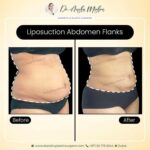 Liposuction Cost in Dubai | Liposuction Surgery in Dubai by Dr. Hans