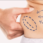 Liposuction Surgery Recovery in Dubai What Experts Recommend