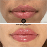 Juvederm for Under Eye Bags: Treatment Insights from the Best Aesthetic Clinics in Dubai