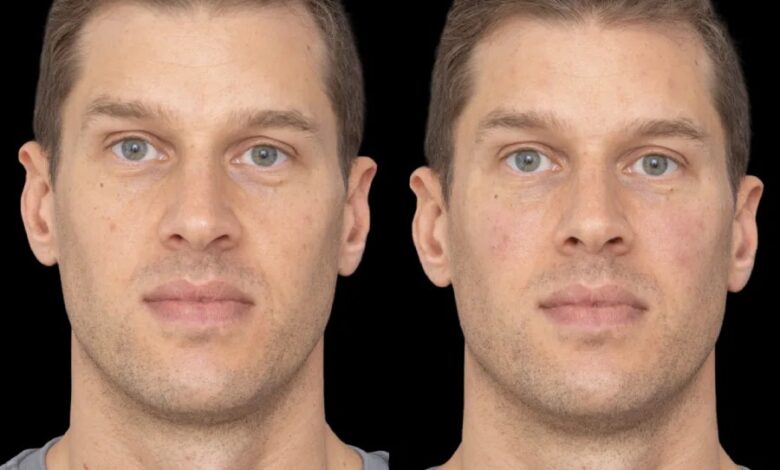 Best Under Eye Fillers See Stunning Results with the Best Doctors in Dubai