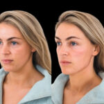 The Anatomy of Perfect Cheek Fillers The Best Doctors in Dubai Explain