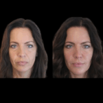 Expert Jawline Filler Techniques at the Best Aesthetic Clinics in dubai
