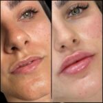 Best Doctors in Dubai for Dermal Fillers: Safe, Natural, and Long-Lasting