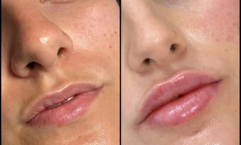 Best Doctors in Dubai for Dermal Fillers: Safe, Natural, and Long-Lasting