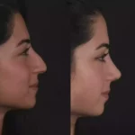 Best Septoplasty Surgeon in Dubai: From Consultation to Care