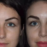 Rhinoplasty in Dubai: Trusted by Thousands of Patients