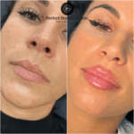 Juvederm for Wrinkles: Say Goodbye to Fine Lines at the Best Aesthetic Clinics in Dubai