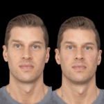 Jawline Fillers vs. Surgery: Best Aesthetic Clinics in dubai Guide