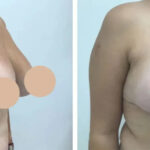What to Expect When Paying for Breast Lift in Dubai Treatment