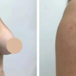 What Makes Dubai a Global Leader in Breast Reduction Treatments