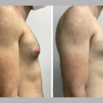 Male Gynecomastia Surgery: Causes and Treatments in Dubai