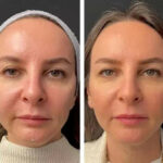 Mesotherapy in Dubai: Expert-Approved Treatments
