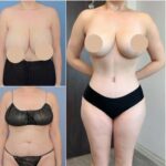 Tummy Tuck in Dubai: Step-by-Step Patient Journey