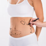 Get the Body You Deserve with Best Liposuction Surgeon in Dubai