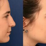 Rhinoplasty in Bangalore at Aesthetic International