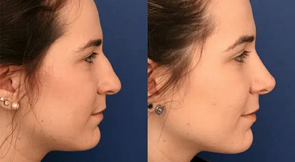 Rhinoplasty in Bangalore at Aesthetic International Rhinoplasty in Bangalore at Aesthetic International