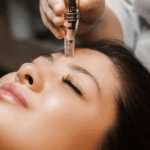 Mesotherapy Treatment Explained for Safe and Effective Beauty Care